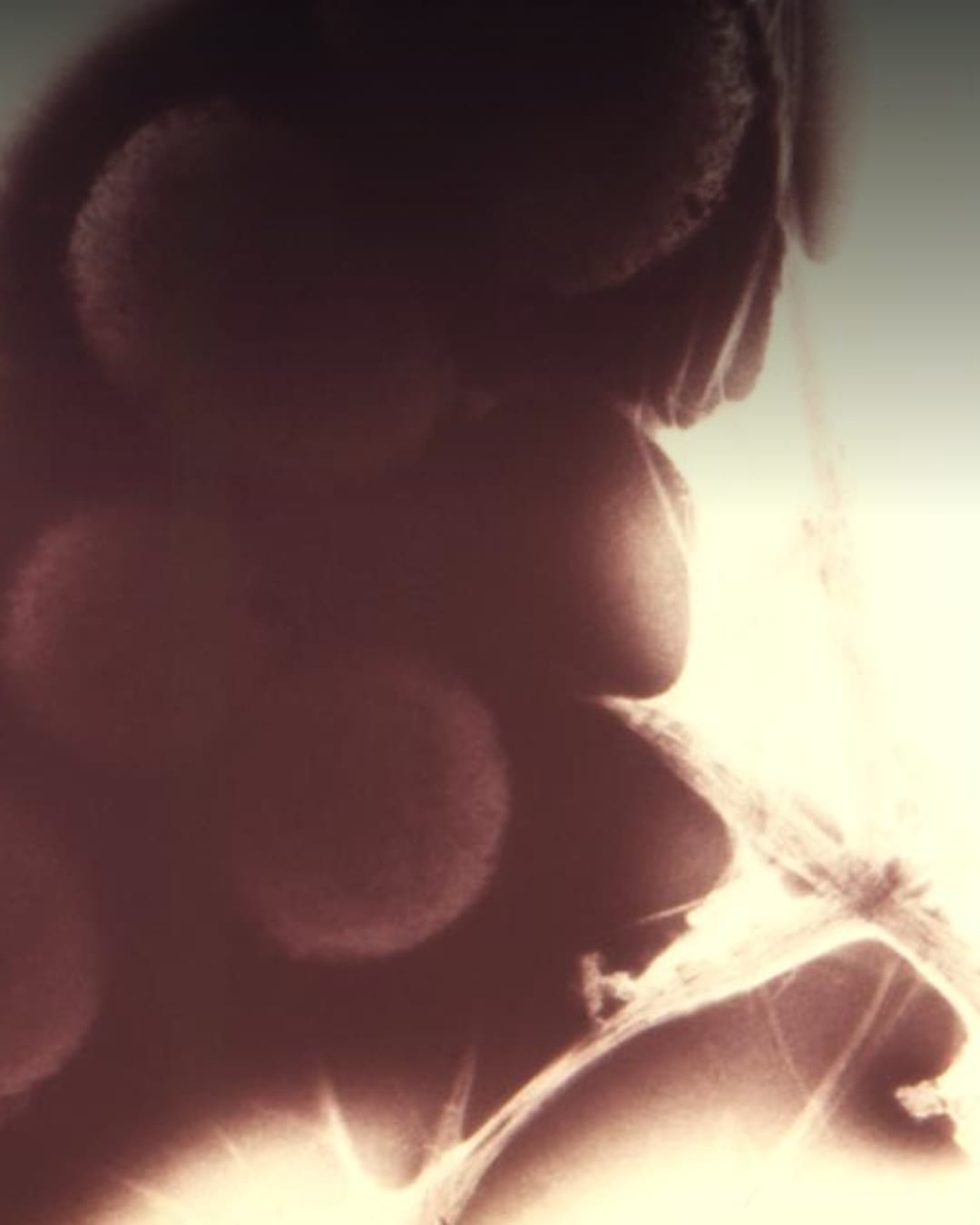 Gonorrhoea and Syphilis Hit Record Levels in Europe, ECDC Says